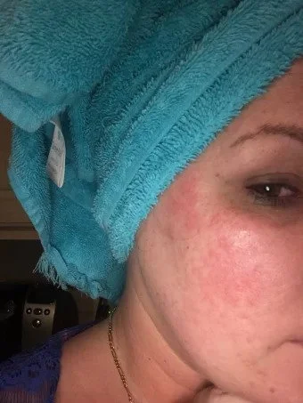 CRUISE'S RASH WAS IN THE SAME SPOT SHE USED FAKE BEN NYE POWDER. PHOTO: COURTESY OF HAVEN CRUISE.