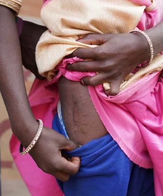 SURMA KUMARI, 11, SHOWS SCARS FROM A MINE COLLAPSE. | PHOTOGRAPHED BY JACK PEARCE.